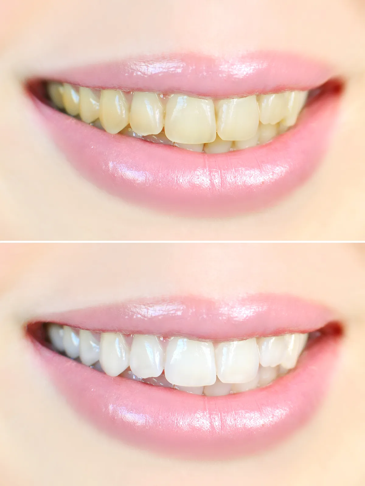 Teeth Whitening: Way to a Bright Smile