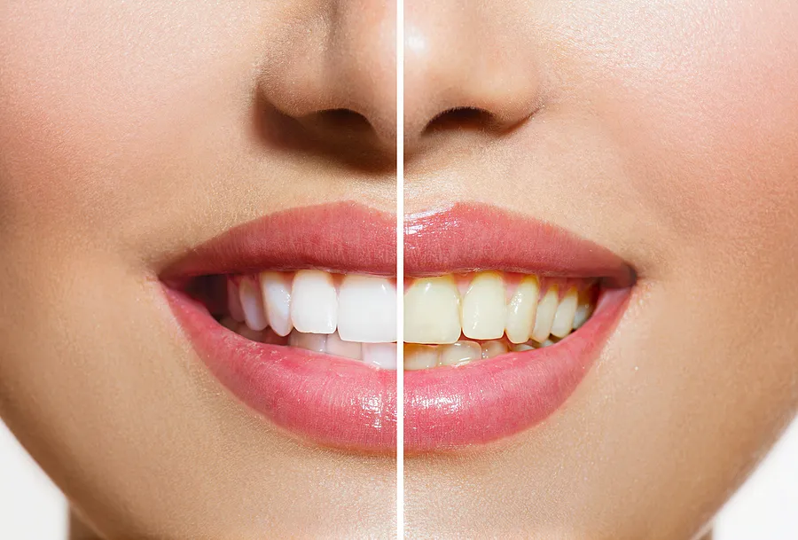 Achieve a Brighter Smile with Professional Teeth Whitening