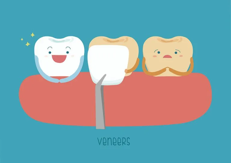 Enhance Your Smile with Veneers: A Comprehensive Guide